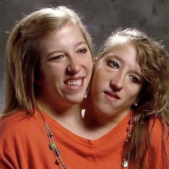Abby And Brittany Hensel Now Separated