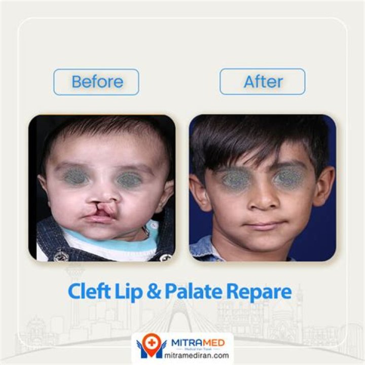 Cleft Palate Before And After The Spotlight