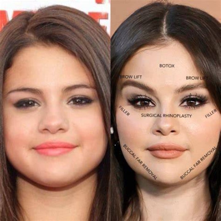 Did Selena Gomez Undergo Vocal Surgery?