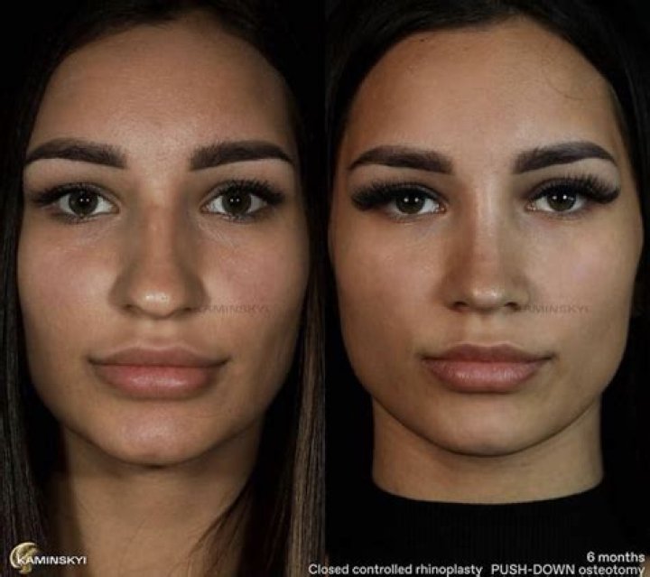 Dr. Miami's Secret? Paris Hilton's Amazing Nose Job Transformation