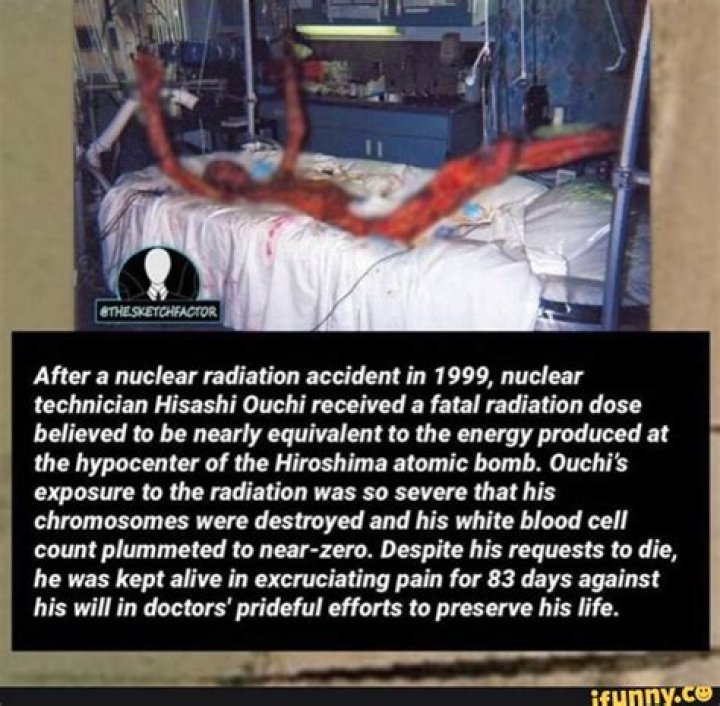 Grisly Photos Of Hisashi Ouchi's Radiation Burns