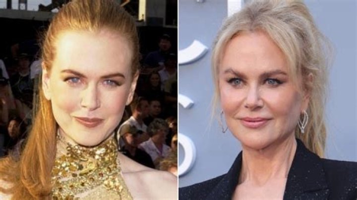 Is Nicole Kidman's Plastic Surgery A Masterpiece Or A Mistake?