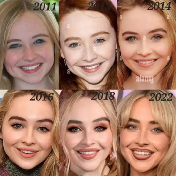 Is Sabrina Carpenter's Chin Transformation The Result Of A Chin Implant?