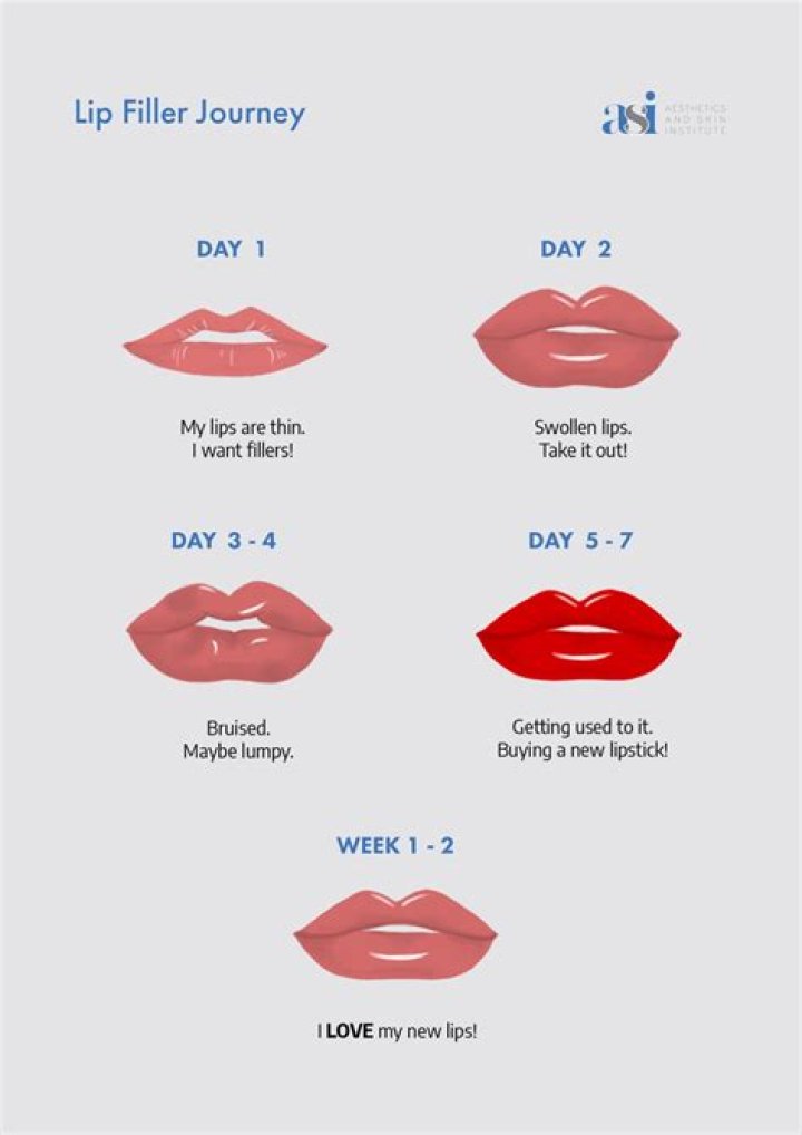 Kimberly Guilfoyle's Lip Filler Journey: A Closer Look