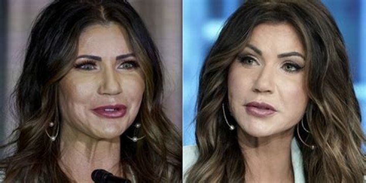 Kristi Noem's Plastic Surgery Journey