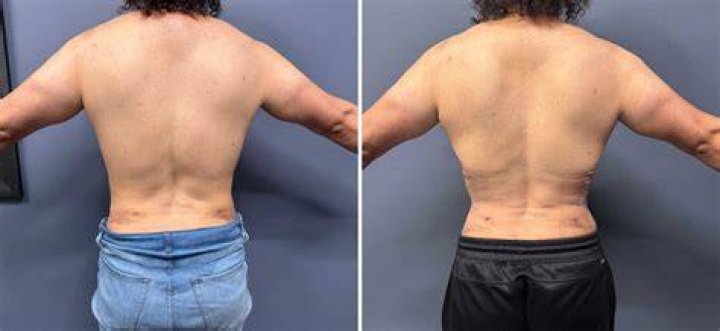 The Ultimate Guide To Before And After Rib Removal