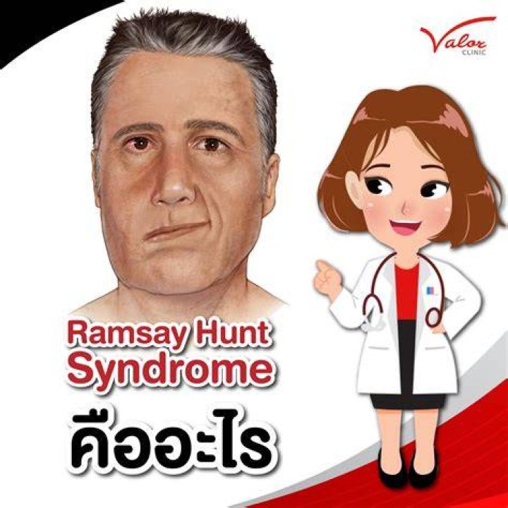 The Ultimate Guide To Ramsay Hunt Syndrome: Causes, Symptoms, And Treatment