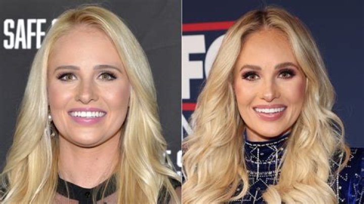 Tomi Lauren's Plastic Surgery Journey