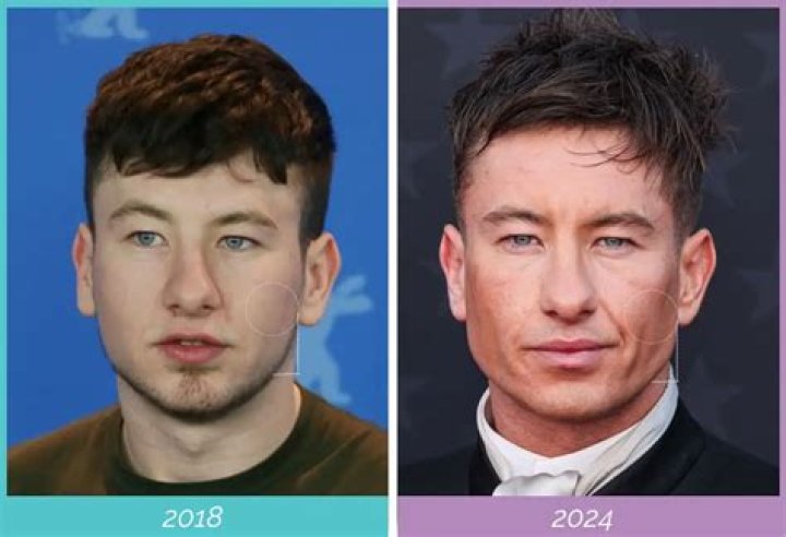 Unveiling Barry Keoghan's Transformation: The Truth Behind His Face Surgery